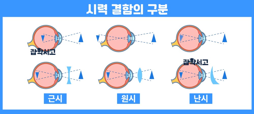 Suy giảm thị lực được phân loại như thế nào và có những đặc điểm gì?